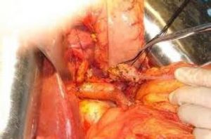 PD（Pancreatoduodenectomy ，胰十二指肠切除术）是壶腹周围癌以及癌前病变的标准治疗术式。